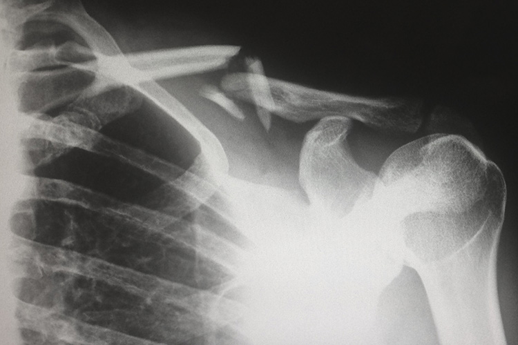 X-ray of a shoulder with a broken clavicle.